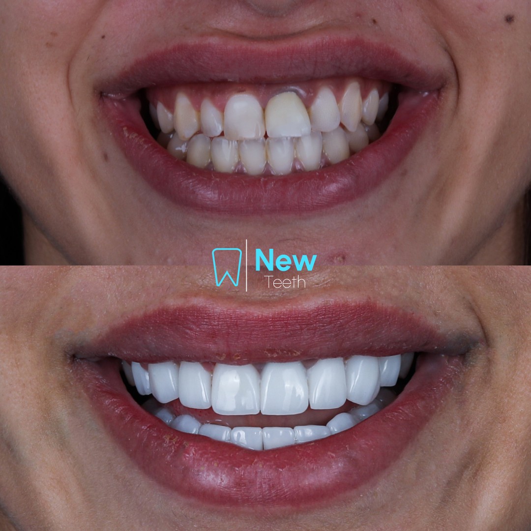 e.Max Veneers Cases