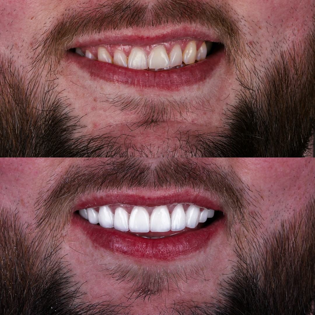 e.Max Veneers Cases