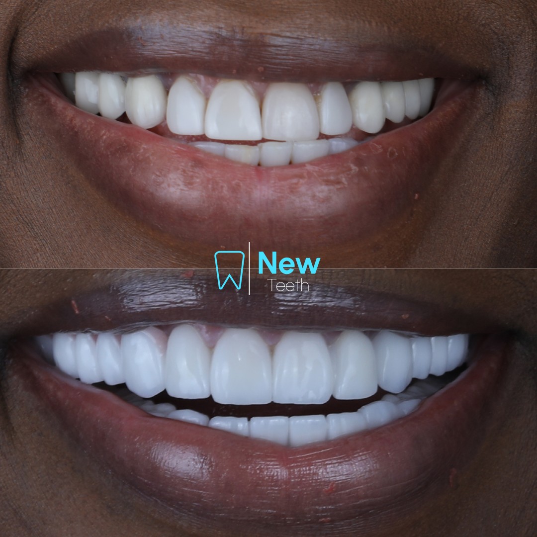 e.Max Veneers Cases